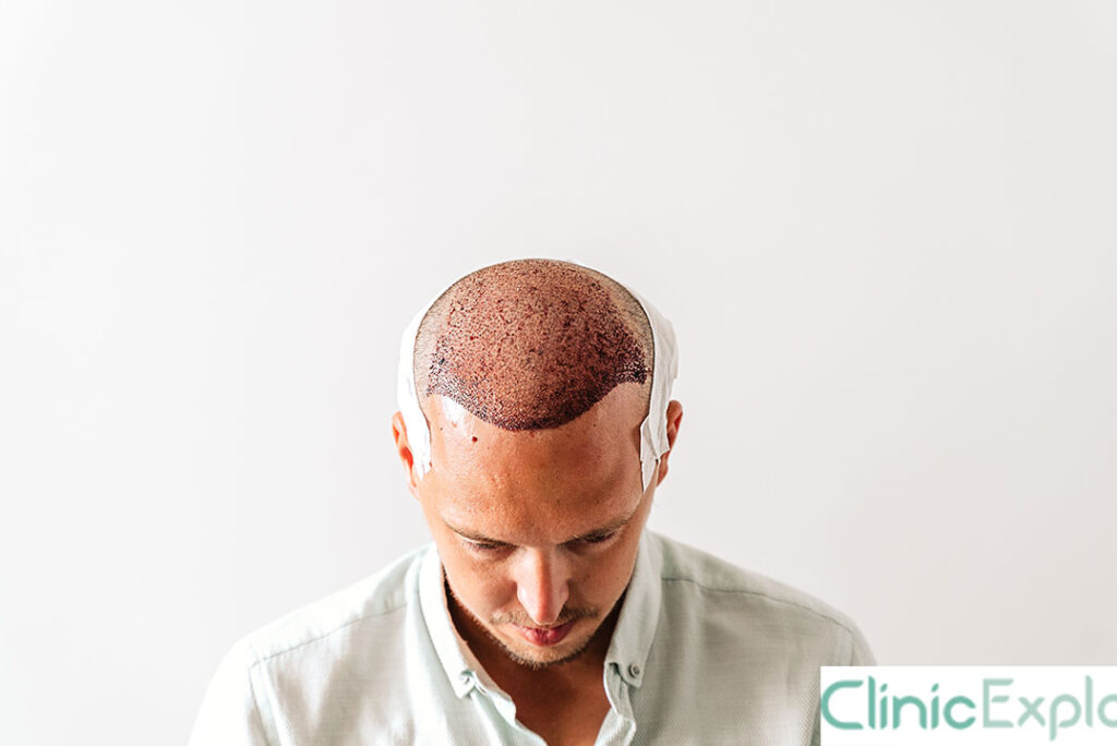 Izmir Bald Spot Removal