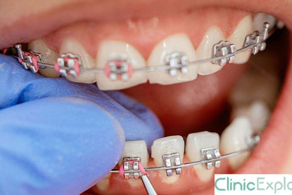 Izmir Braces