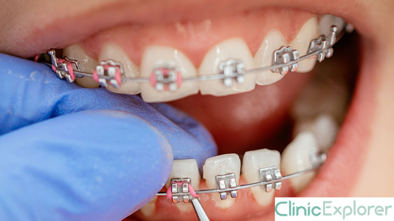 Izmir Braces