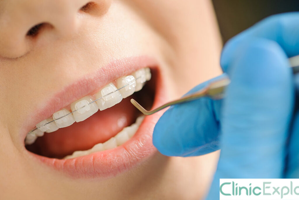 Izmir Ceramic Braces