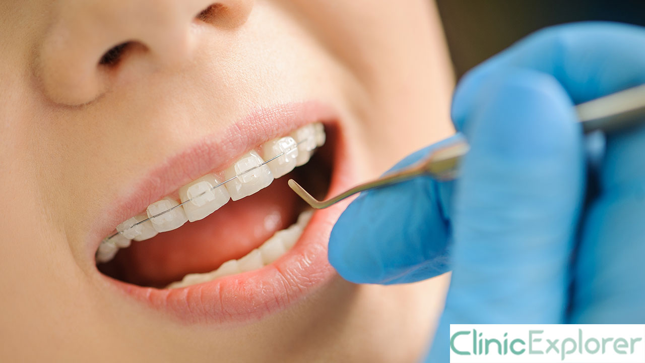 Izmir Ceramic Braces