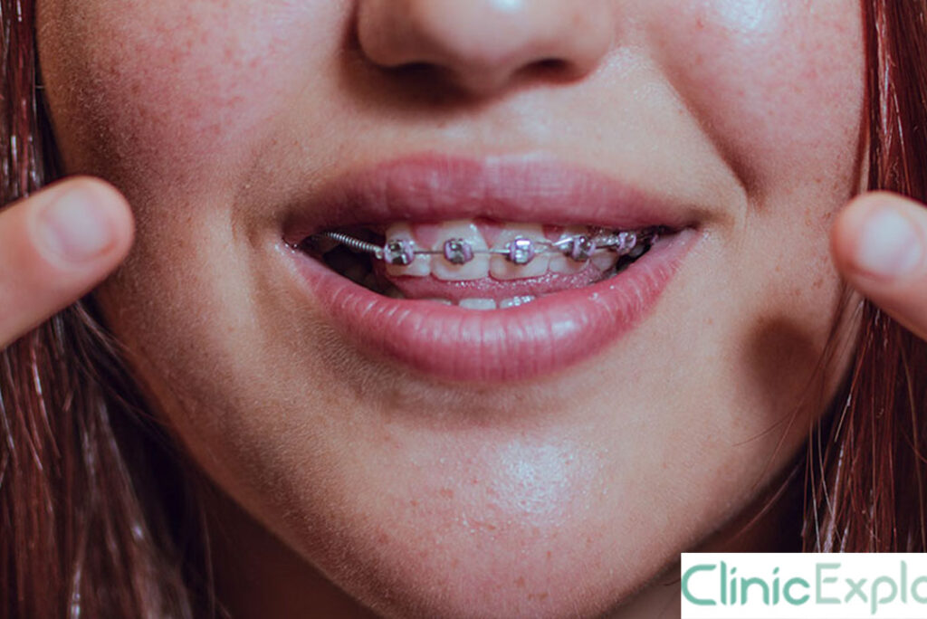 Izmir Accelerated Brackets