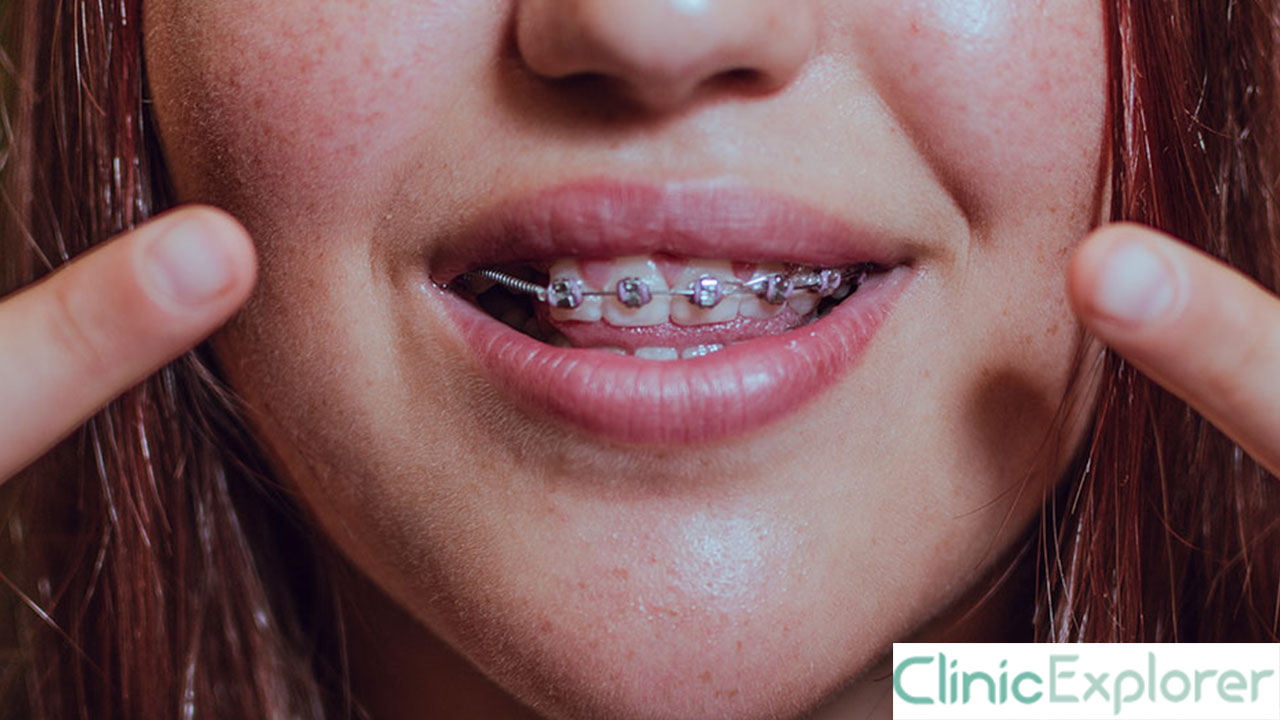 Izmir Accelerated Brackets